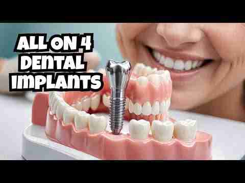 All-on-4 Implants: All you need to know