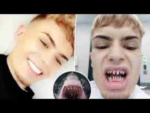 #37: Dental Veneer Complications