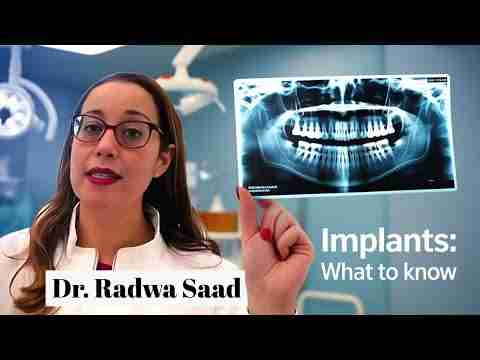 Dental Implants: What to Expect Before, During, and After