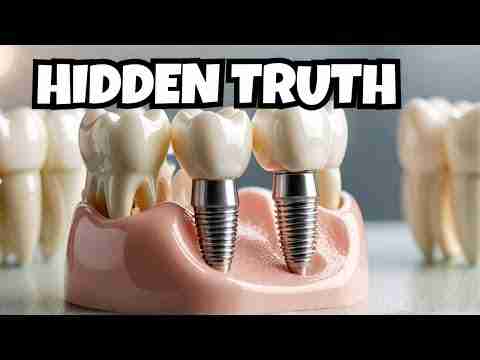 Dental Implants: All you need to know